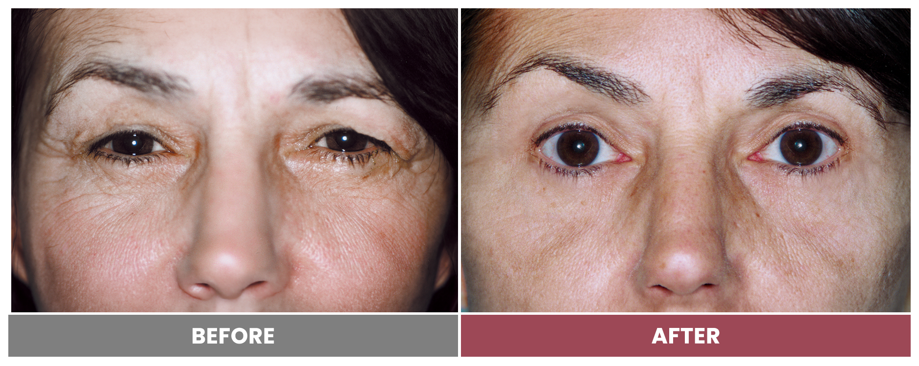 Upper Blepharoplasty - Case 90